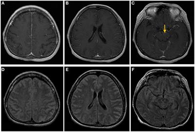 Atypical Cerebral Manifestations of Disseminated Mycobacterium tuberculosis